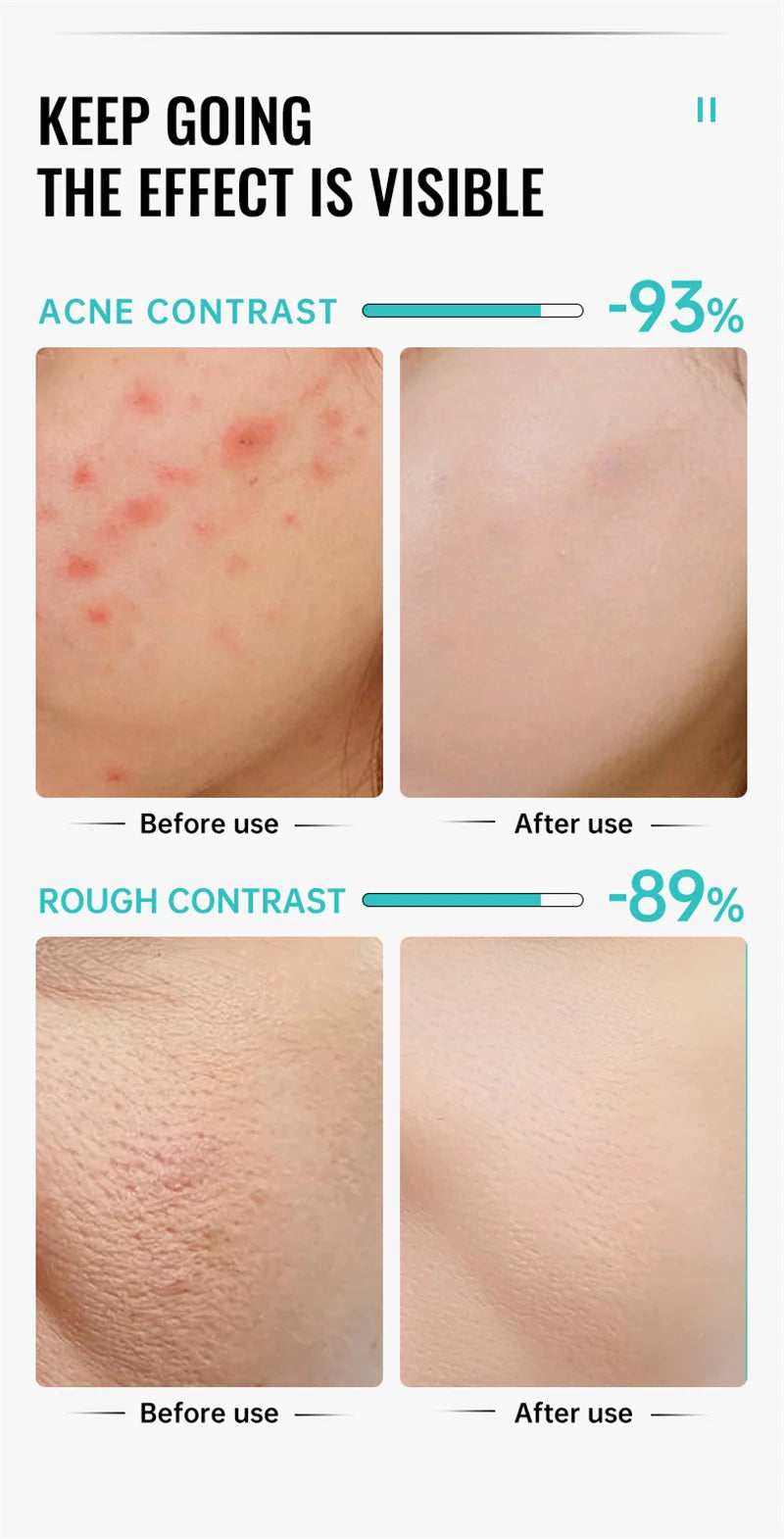 Crème pour le visage à l'acide salicylique, élimination de l'acné, contrôle de l'huile, rétrécit les Pores, éclaircit les marques d'acné, Gel de mélanine, soins pour la peau lisses, beauté coréenne 30g