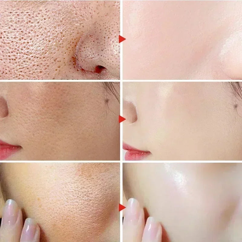 Sérum rétrécit les Pores, acide de fruits salicylique pour le visage, élimine les points noirs, réduit l'acné, contrôle du sébum, Gel blanchissant, hydratant, peau lisse