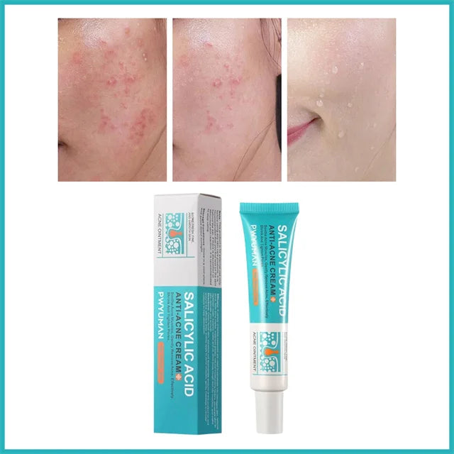 Crème pour le visage à l'acide salicylique, élimination de l'acné, contrôle de l'huile, rétrécit les Pores, éclaircit les marques d'acné, Gel de mélanine, soins pour la peau lisses, beauté coréenne 30g