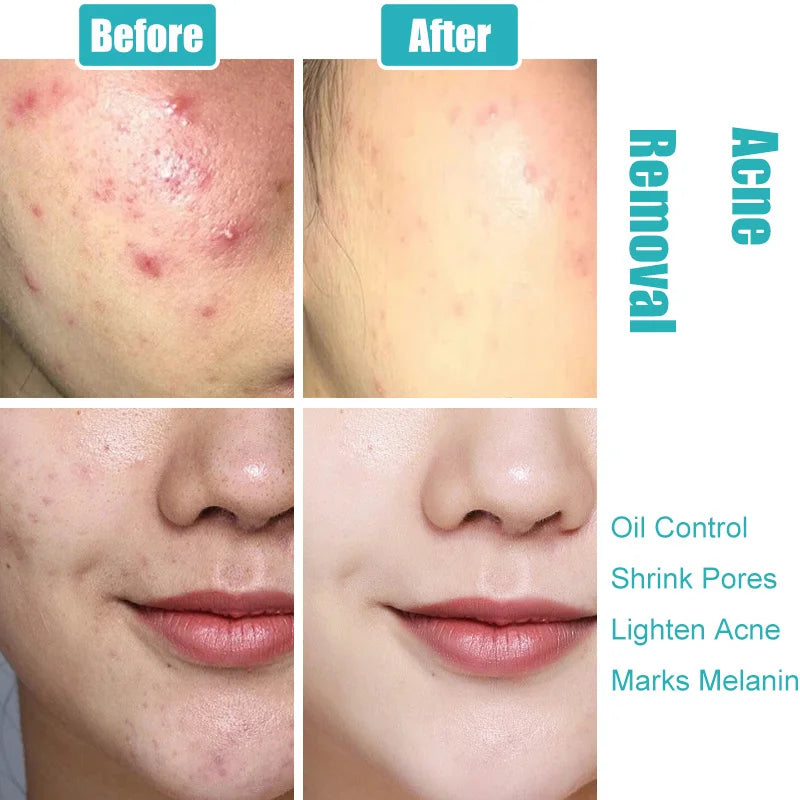 Crème pour le visage à l'acide salicylique, élimination de l'acné, contrôle de l'huile, rétrécit les Pores, éclaircit les marques d'acné, Gel de mélanine, soins pour la peau lisses, beauté coréenne 30g