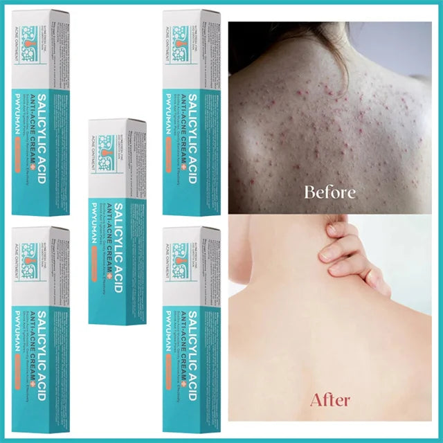 Crème pour le visage à l'acide salicylique, élimination de l'acné, contrôle de l'huile, rétrécit les Pores, éclaircit les marques d'acné, Gel de mélanine, soins pour la peau lisses, beauté coréenne 30g