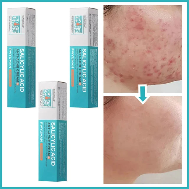 Crème pour le visage à l'acide salicylique, élimination de l'acné, contrôle de l'huile, rétrécit les Pores, éclaircit les marques d'acné, Gel de mélanine, soins pour la peau lisses, beauté coréenne 30g