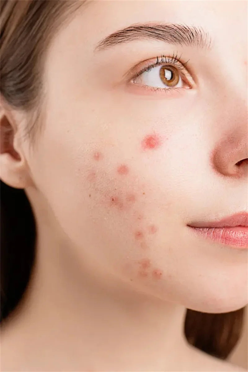 Crème pour le visage à l'acide salicylique, élimination de l'acné, contrôle de l'huile, rétrécit les Pores, éclaircit les marques d'acné, Gel de mélanine, soins pour la peau lisses, beauté coréenne 30g